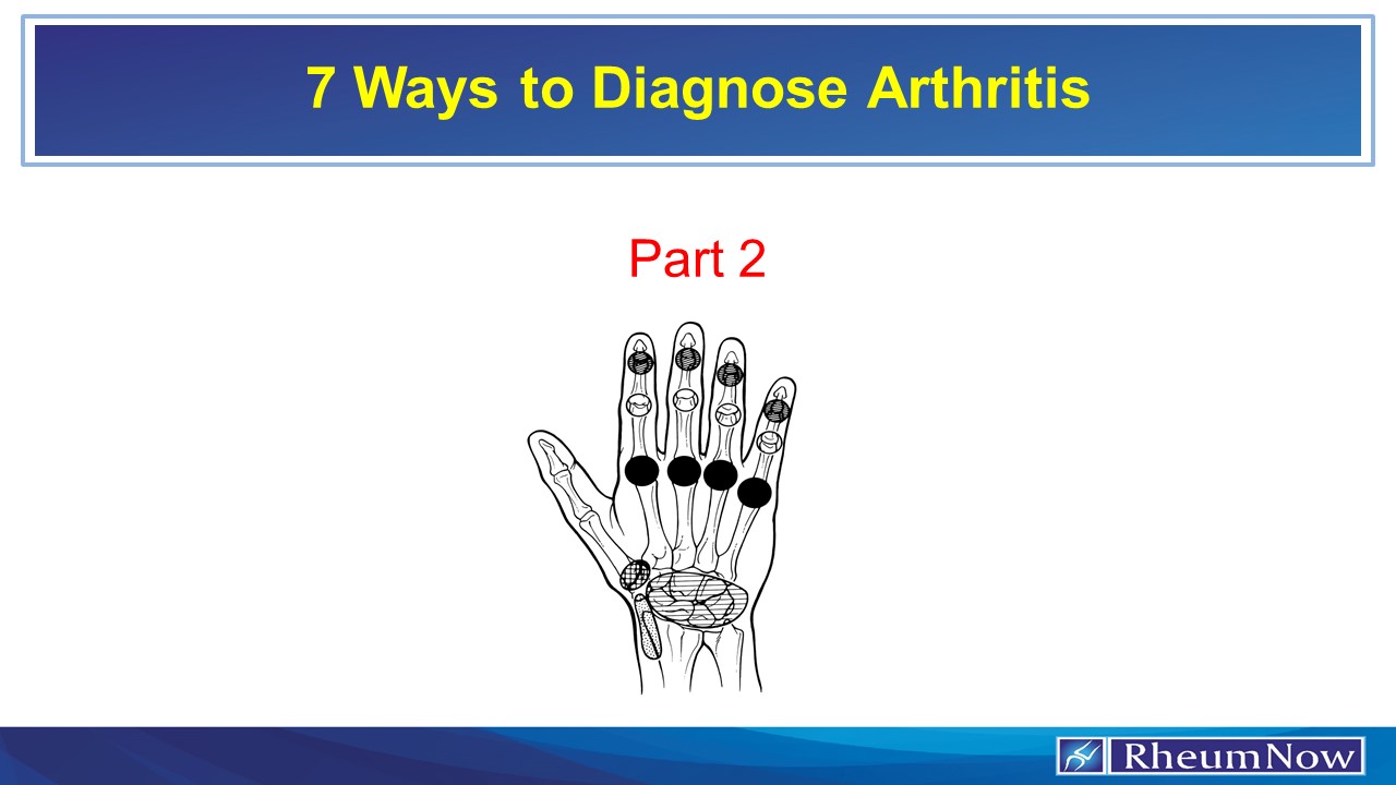 Seven Ways to Diagnose Arthritis RheumNow